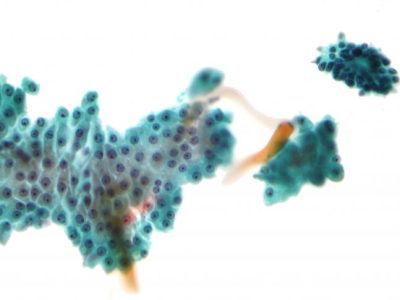 Fibrocystic_changes_of_breast_-_cytology_1