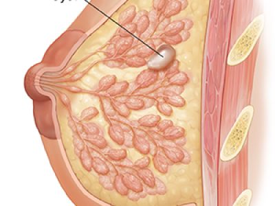Midsagittal section of breast with cyst and chest wall.  SOURCE: Original art