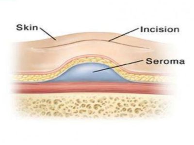 seroma-presentation-5-1024